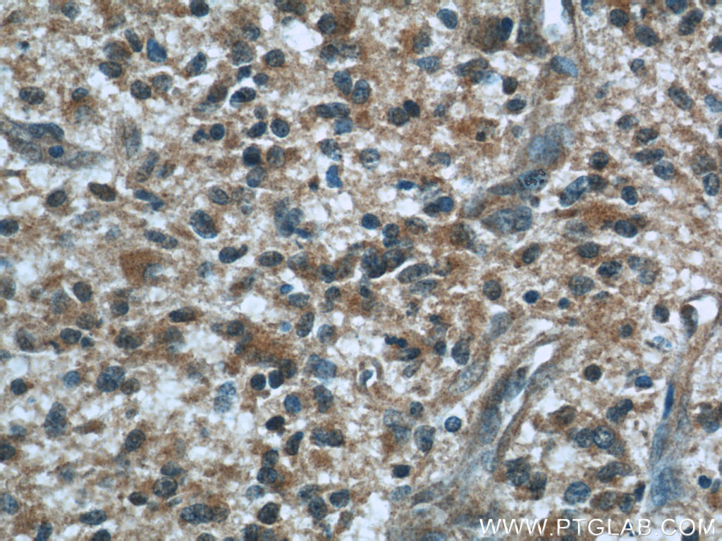 IHC staining of human gliomas using 60212-1-Ig (same clone as 60212-1-PBS)