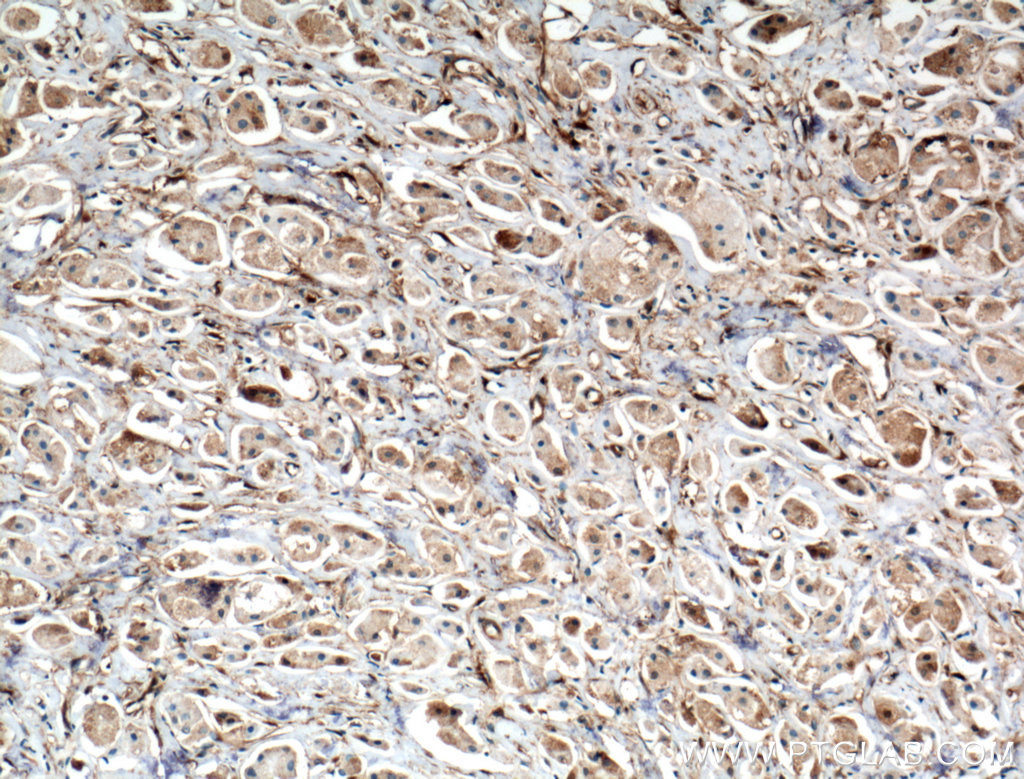 IHC staining of human breast cancer using 27207-1-AP