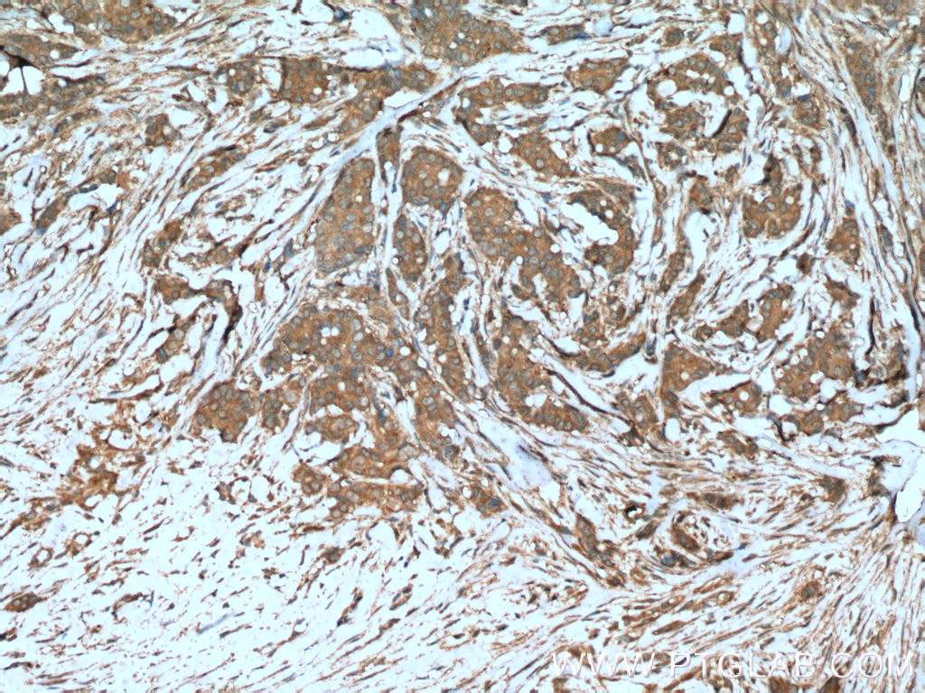 IHC staining of human breast cancer using 11306-1-AP