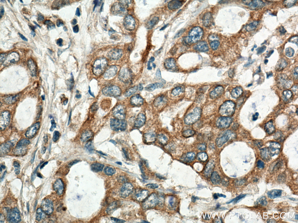 IHC staining of human pancreas cancer using 14956-1-AP