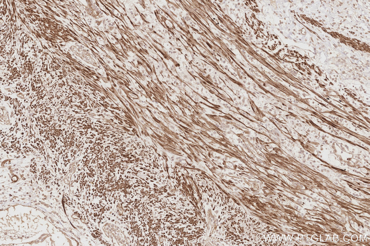 IHC staining of human appendicitis using 12390-1-AP IHC staining of human appendicitis using 12390-1-AP