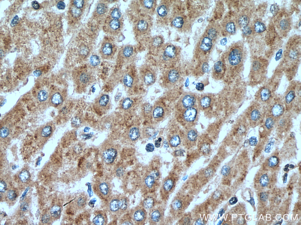 IHC staining of human liver cancer using 25281-1-AP