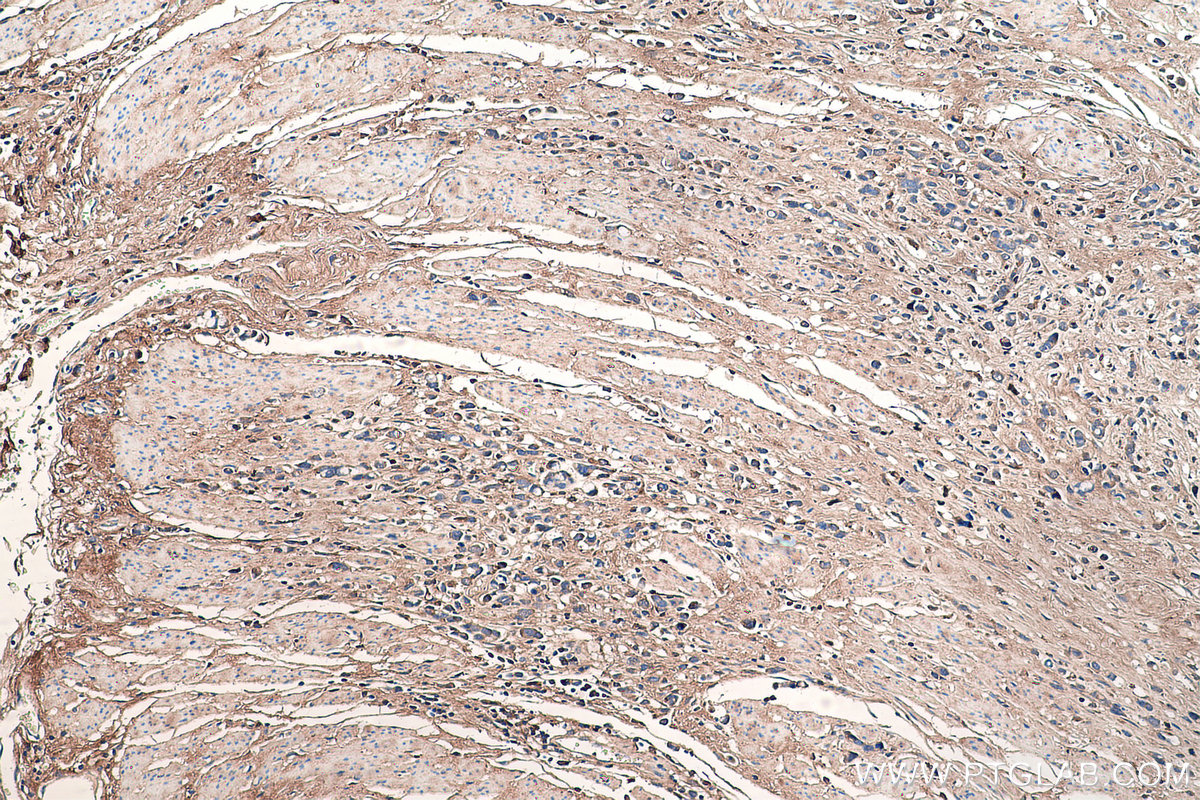IHC staining of human stomach cancer using 16409-1-AP