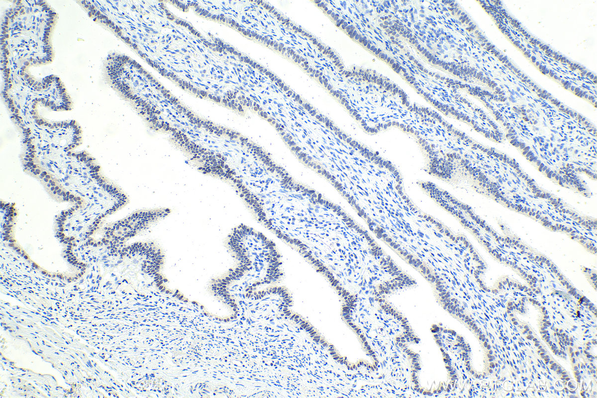 IHC staining of human ovary tumor using 12688-1-AP