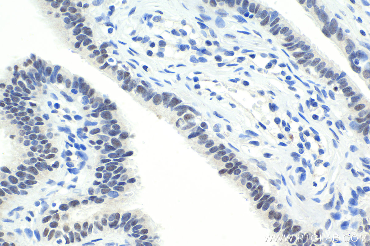 IHC staining of human ovary tumor using 12688-1-AP