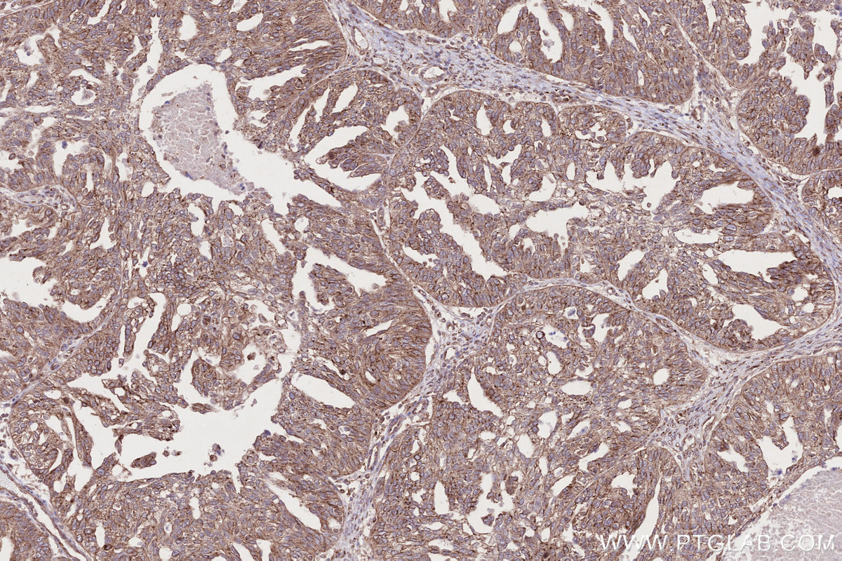 IHC staining of human ovary cancer using 29603-1-AP IHC staining of human ovary cancer using 29603-1-AP
