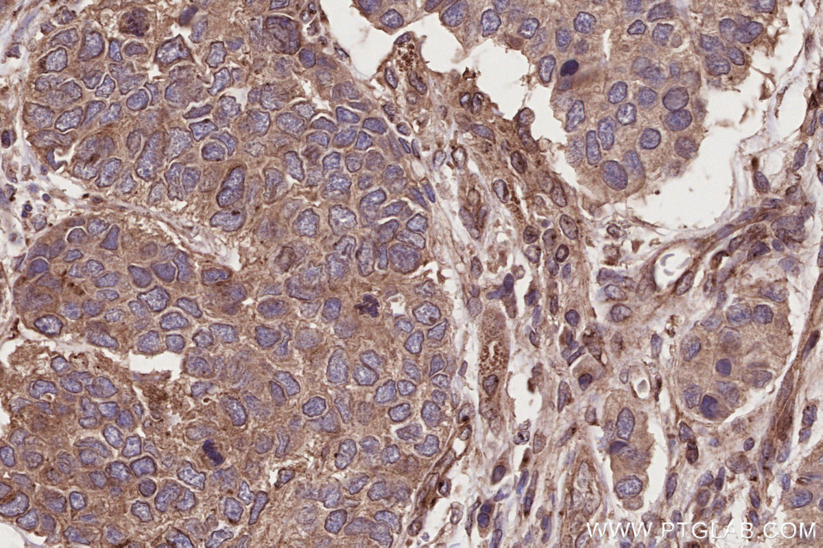 IHC staining of human stomach cancer using 29603-1-AP IHC staining of human stomach cancer using 29603-1-AP