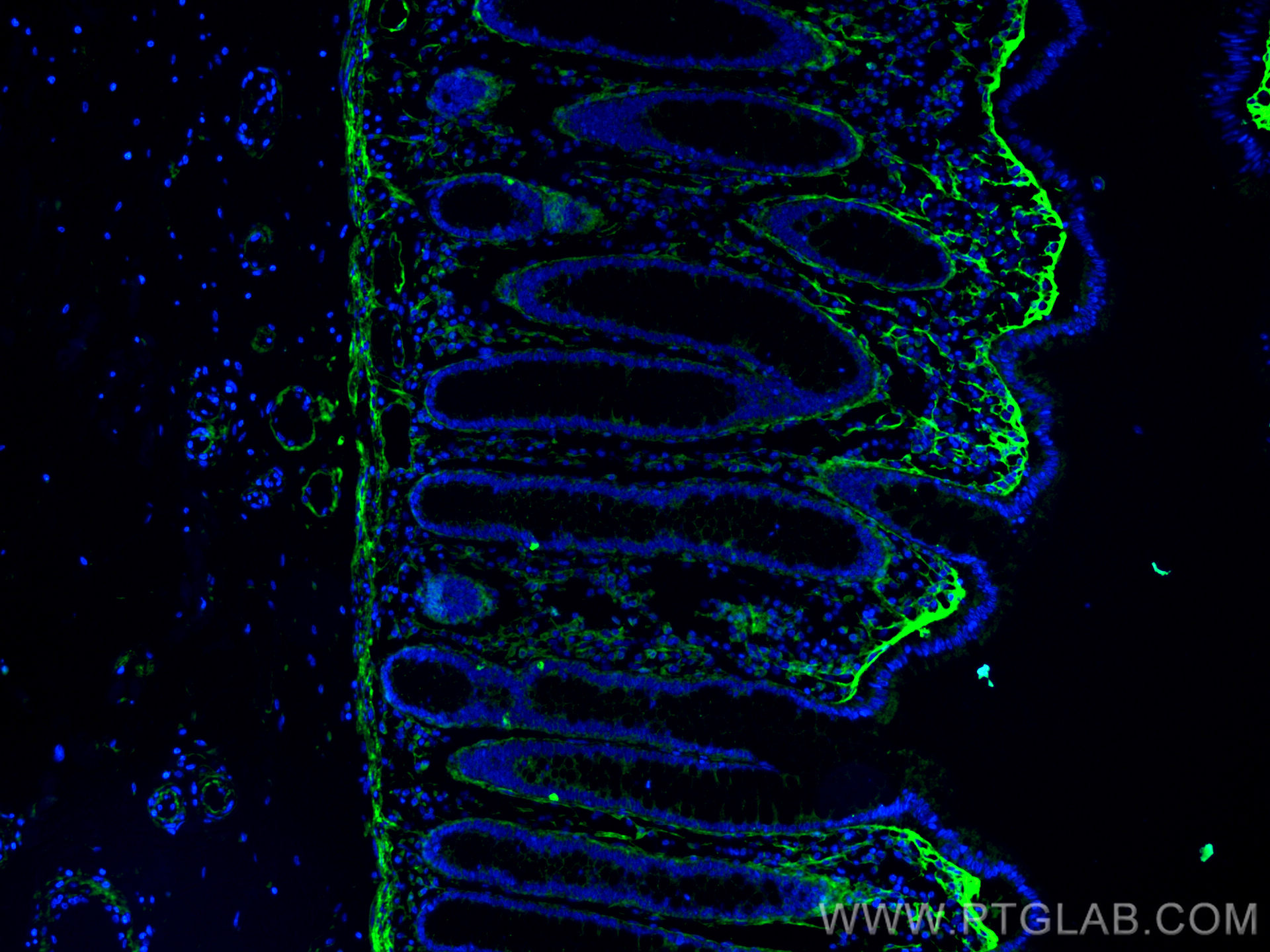 IF Staining of human colon cancer using 60007-1-Ig