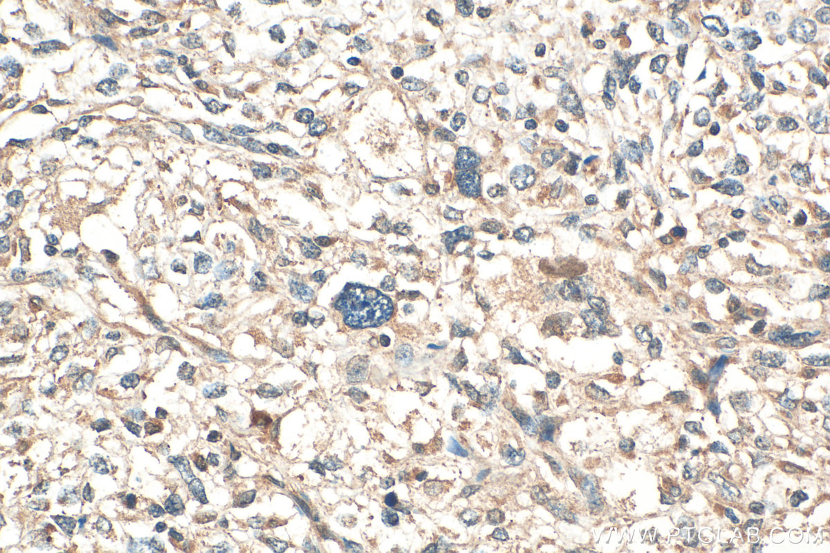 IHC staining of human pancreas cancer using 25432-1-AP (same clone as 25432-1-PBS)
