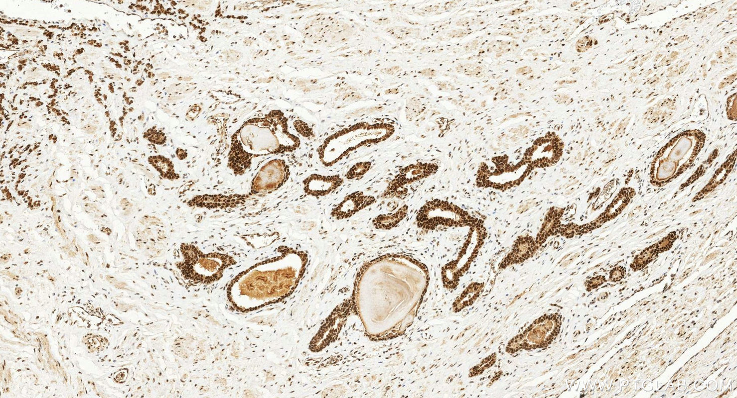 IHC staining of human prostate cancer using 10832-1-AP