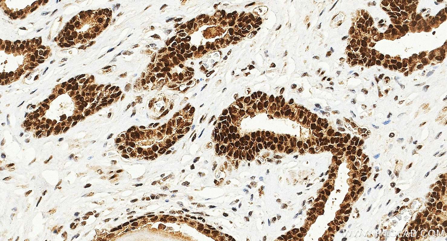 IHC staining of human prostate cancer using 10832-1-AP