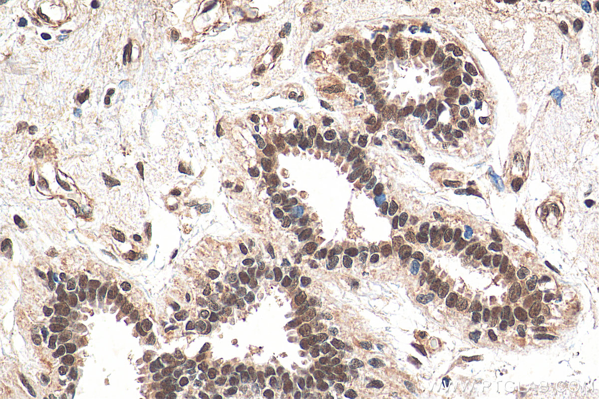 IHC staining of human breast cancer using 66161-1-Ig (same clone as 66161-1-PBS)
