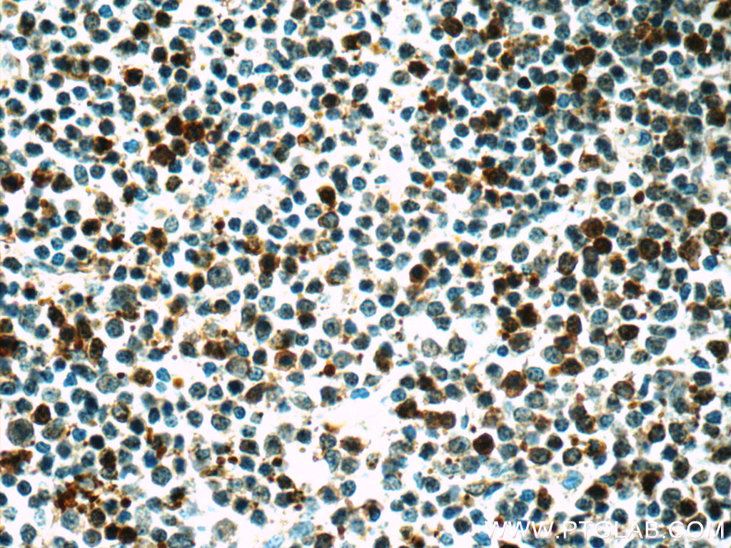 IHC staining of human lymphoma using 66161-1-Ig (same clone as 66161-1-PBS)
