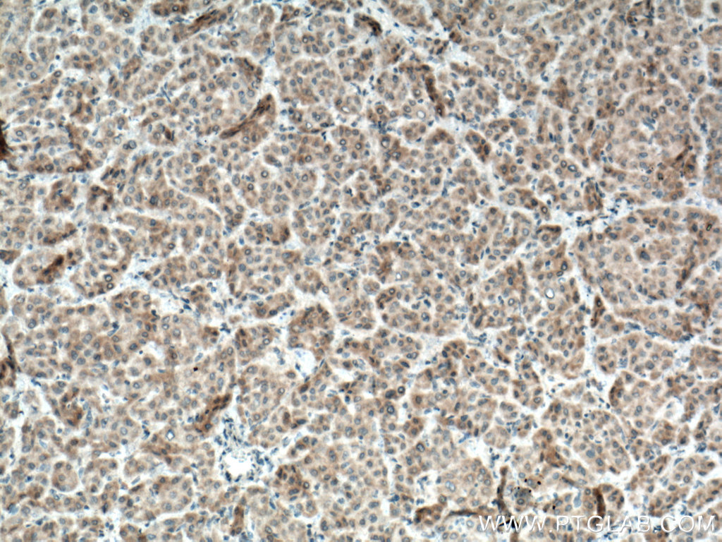 IHC staining of human liver cancer using 22188-1-AP (same clone as 22188-1-PBS)