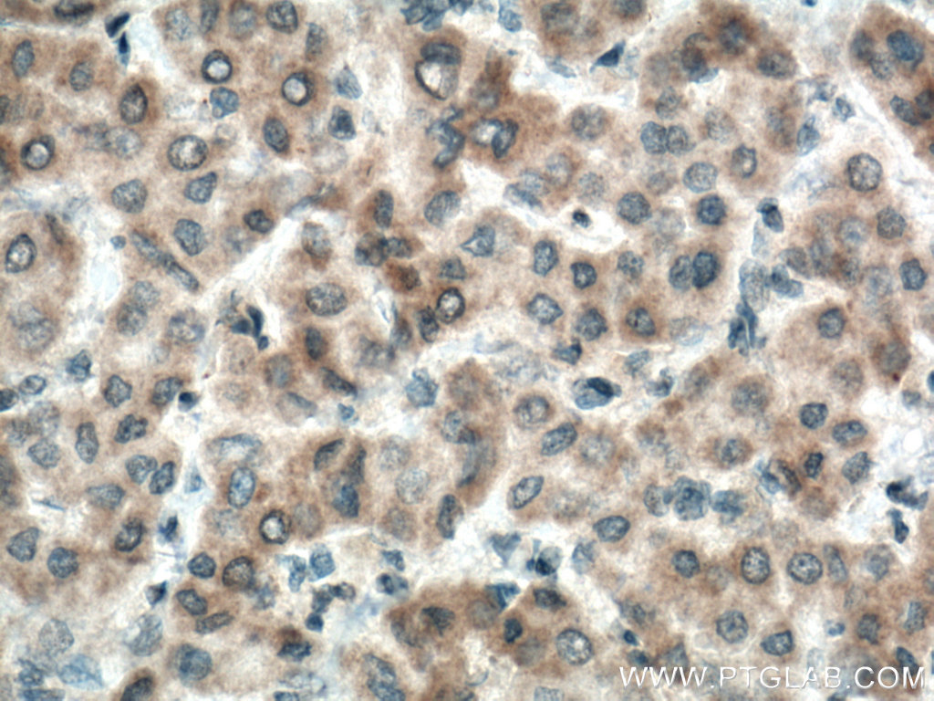 IHC staining of human liver cancer using 22188-1-AP (same clone as 22188-1-PBS)