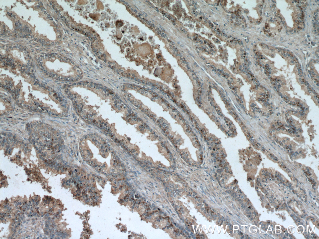 IHC staining of human prostate hyperplasia using 12492-1-AP