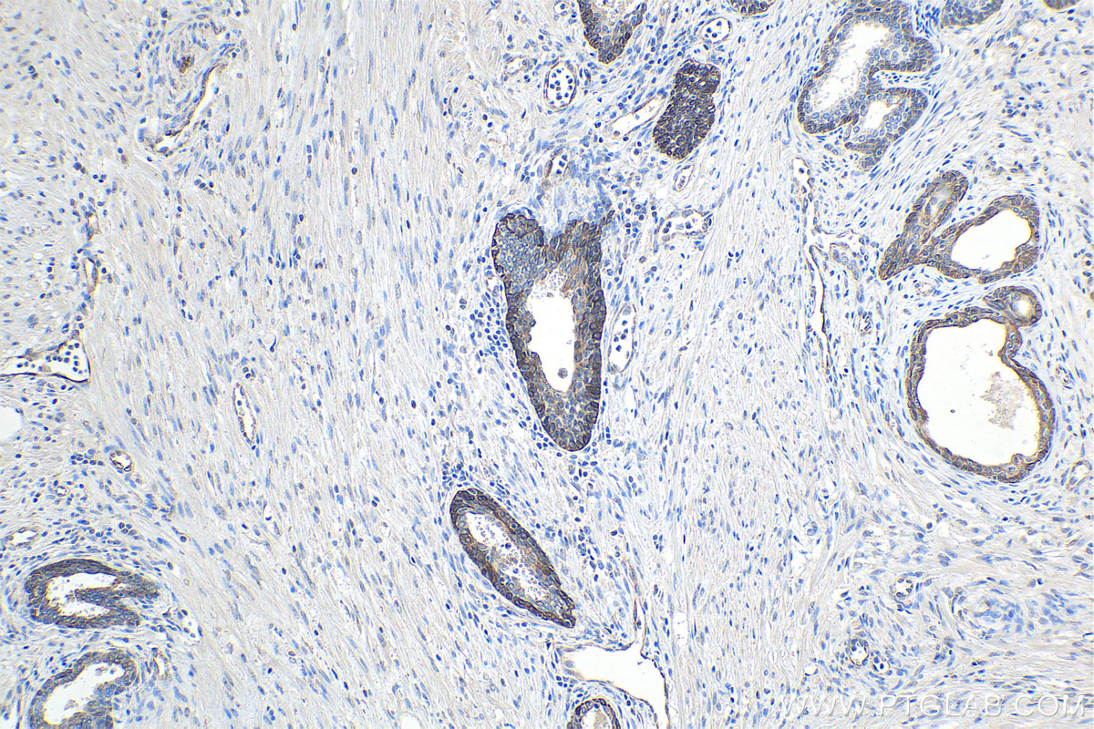 IHC staining of human prostate cancer using 68118-1-Ig (same clone as 68118-1-PBS)
