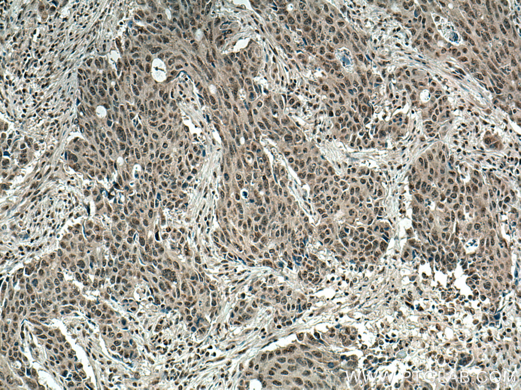 IHC staining of human colon cancer using 28366-1-AP