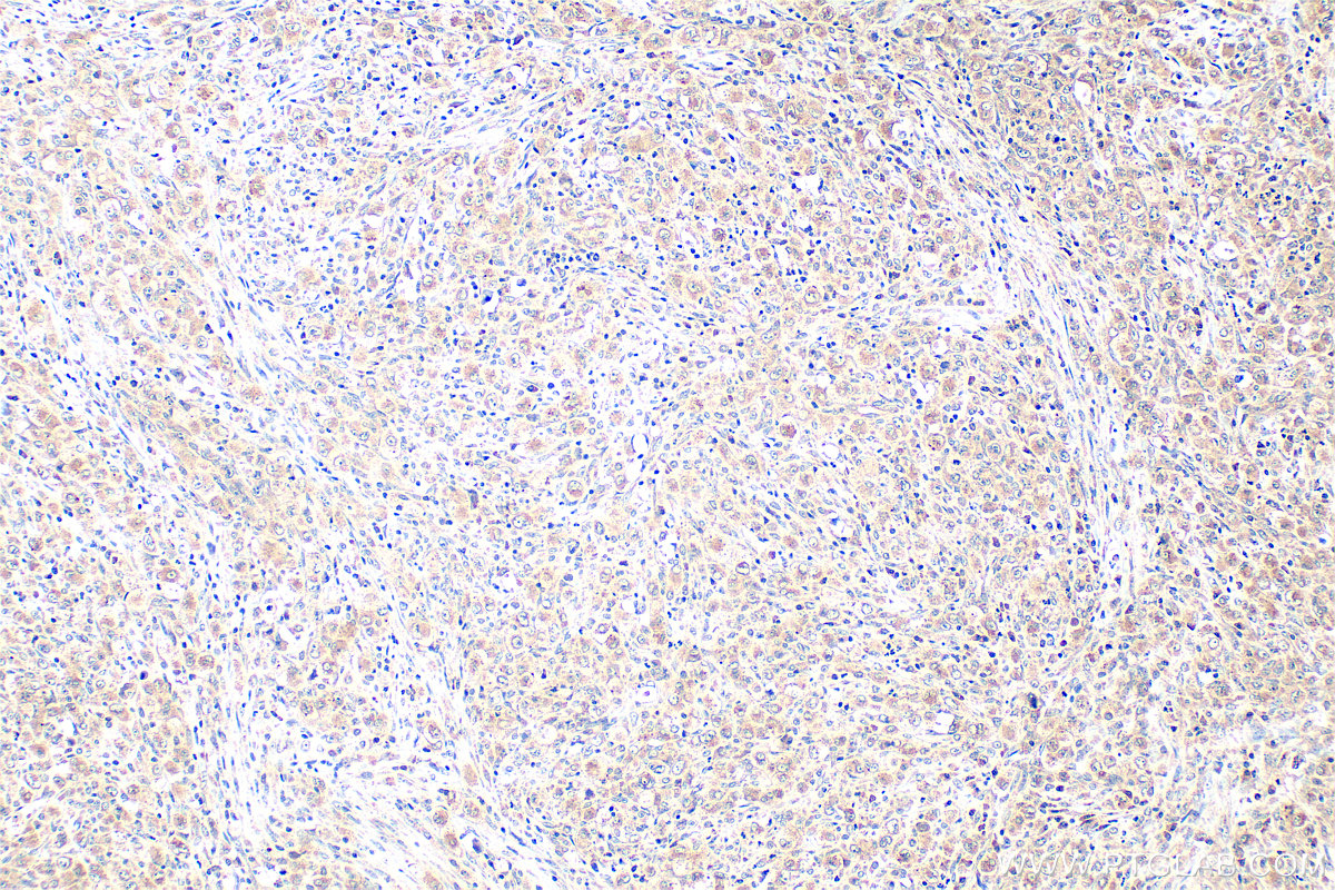 IHC staining of human lymphoma using 20899-1-AP