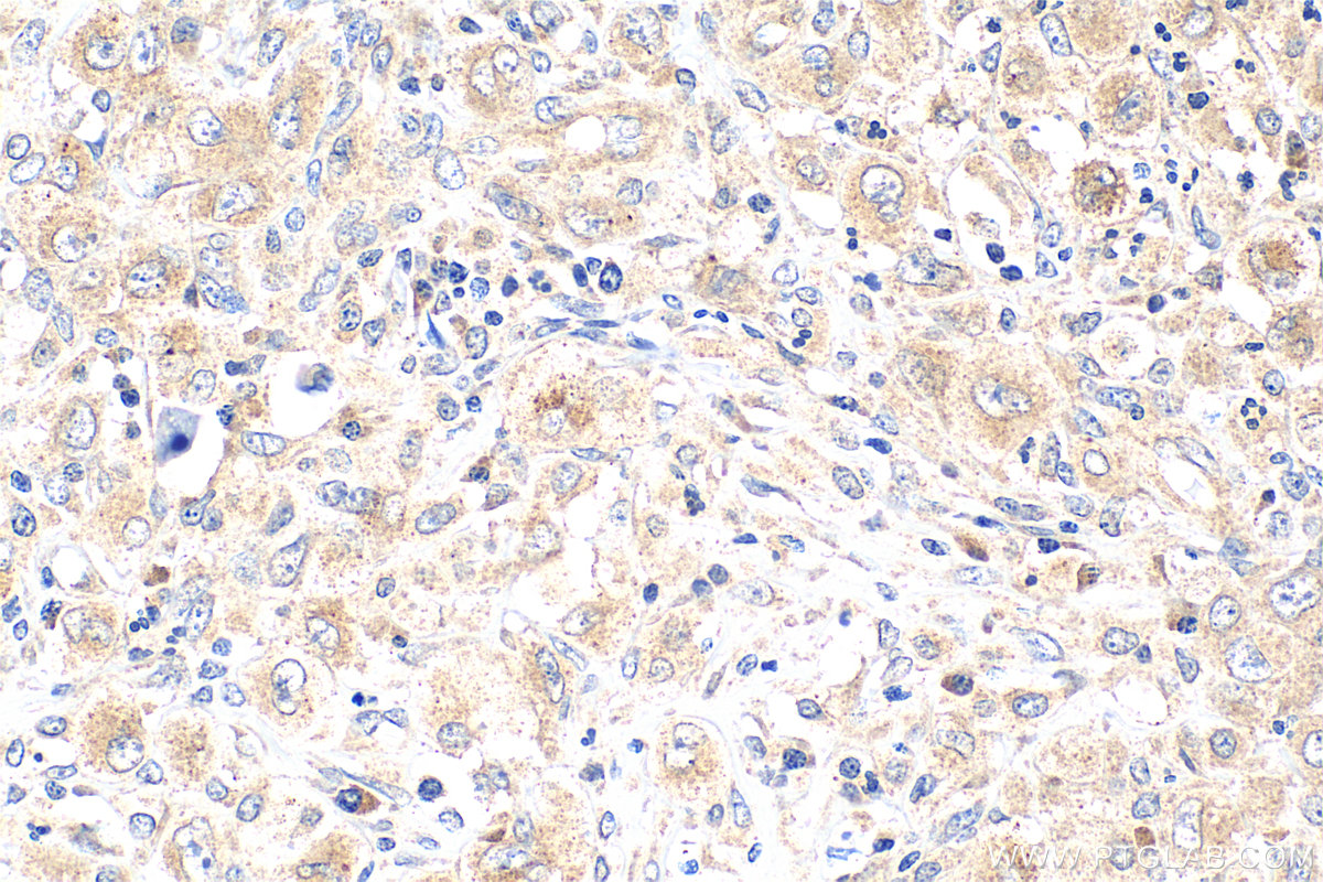 IHC staining of human lymphoma using 20899-1-AP