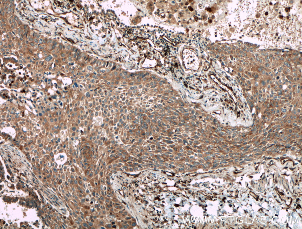 IHC staining of human lung cancer using 27431-1-AP