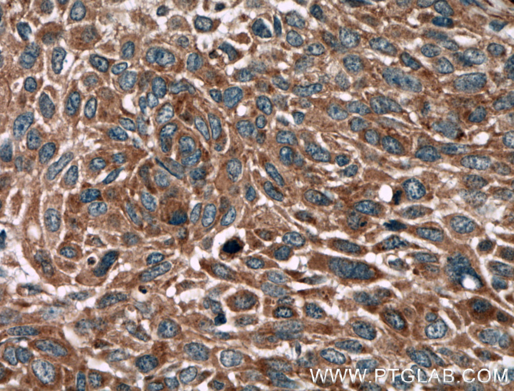 IHC staining of human lung cancer using 27431-1-AP