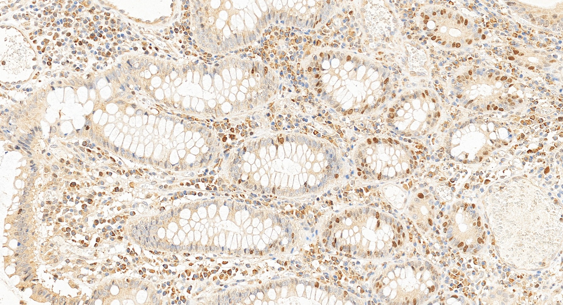 IHC staining of human colon cancer using 22362-1-AP