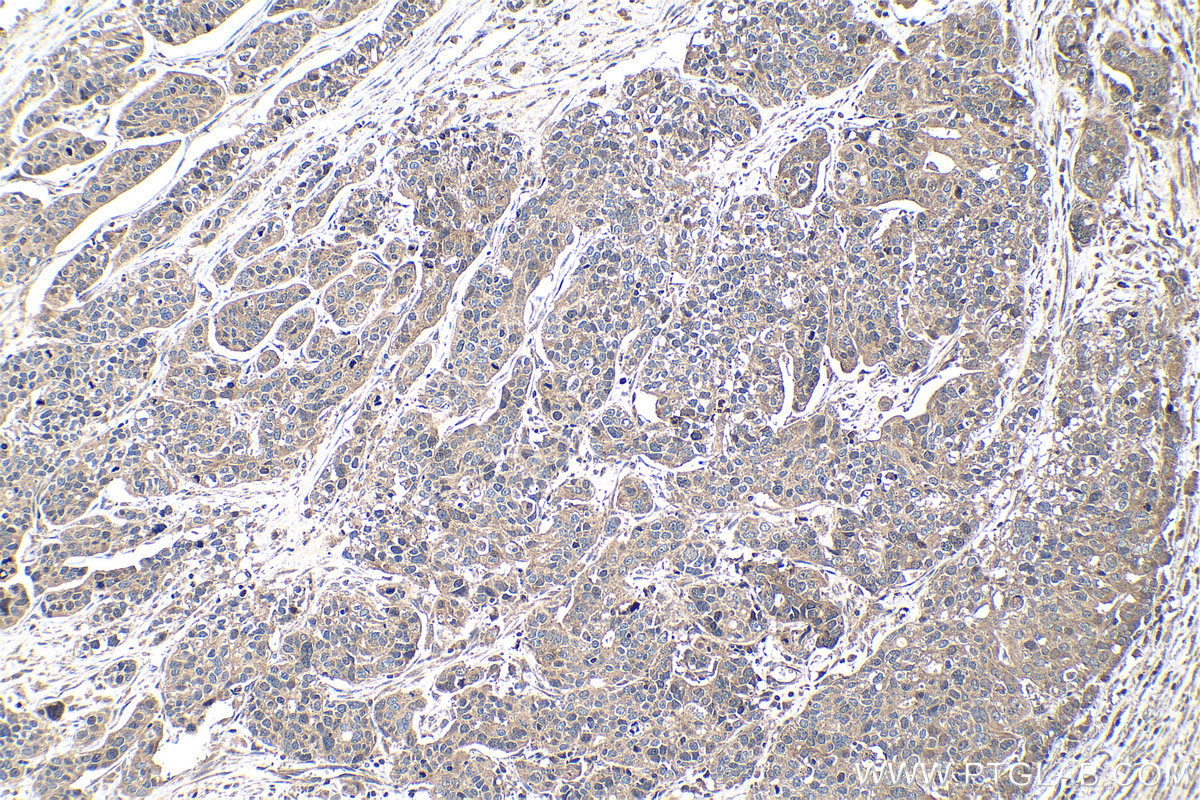 Immunohistochemical analysis of paraffin-embedded human ovary tumor tissue slide using 22362-1-AP (BRCA1 antibody) at dilution of 1:1000 (under 10x lens). Heat mediated antigen retrieval with Tris-EDTA buffer (pH 9.0). IHC staining of human ovary tumor using 22362-1-AP
