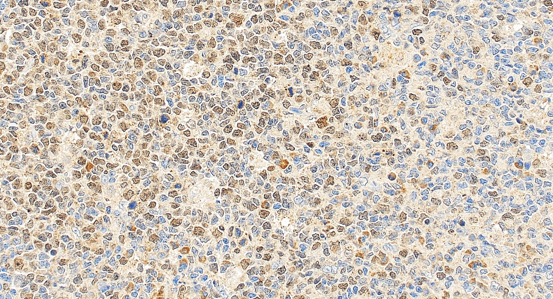 IHC staining of human tonsillitis using 22362-1-AP
