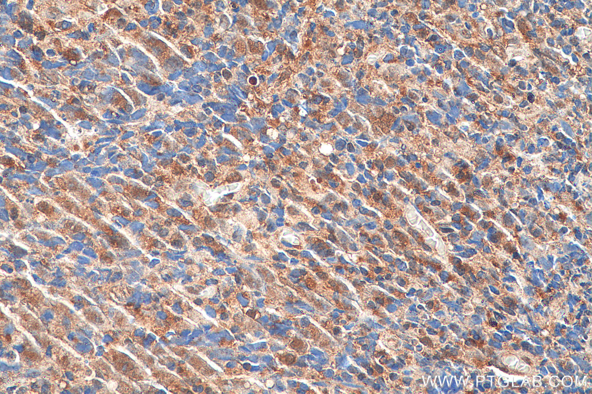 IHC staining of human nasopharyngeal carcinoma using 15391-1-AP