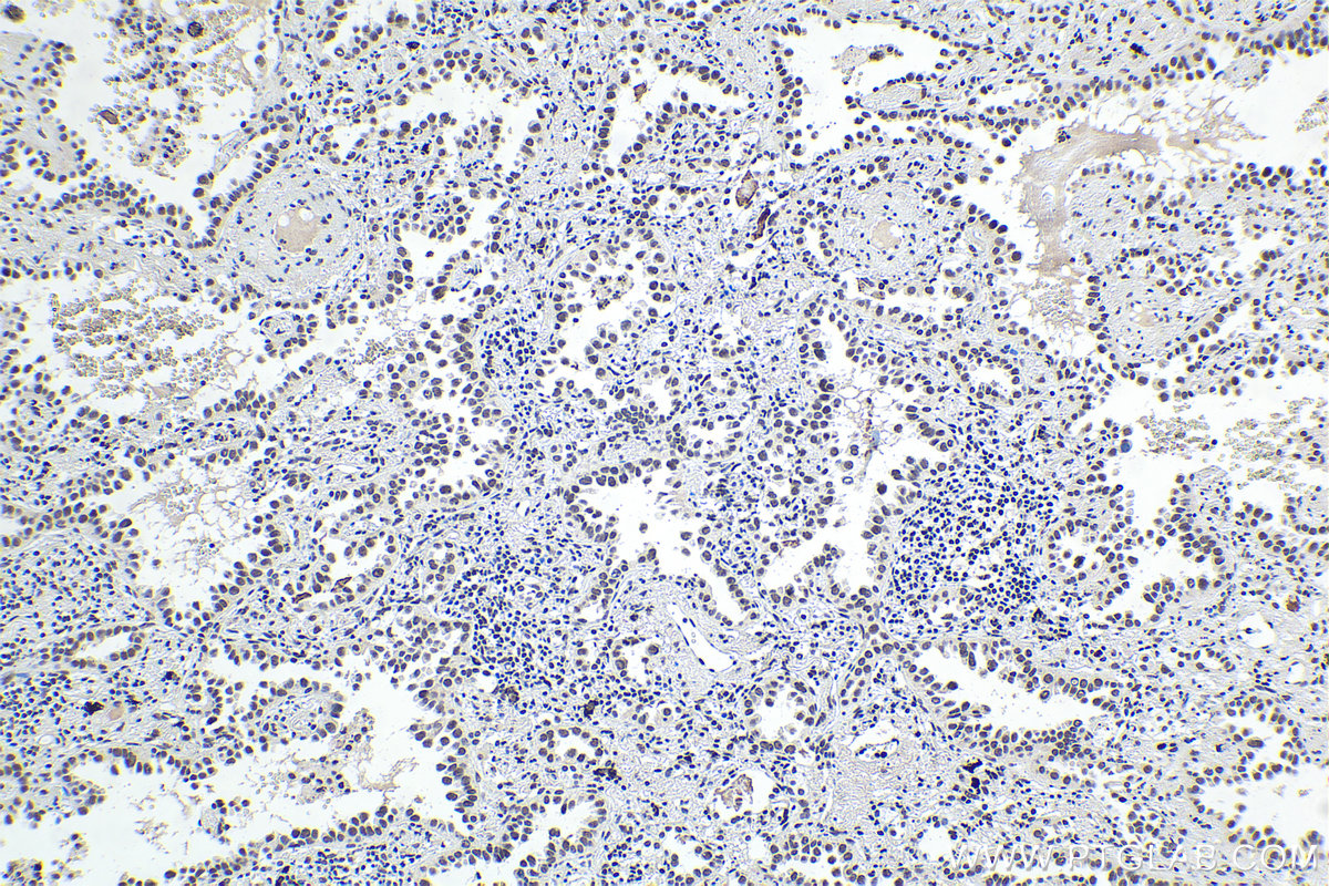 IHC staining of human lung cancer using 28486-1-AP