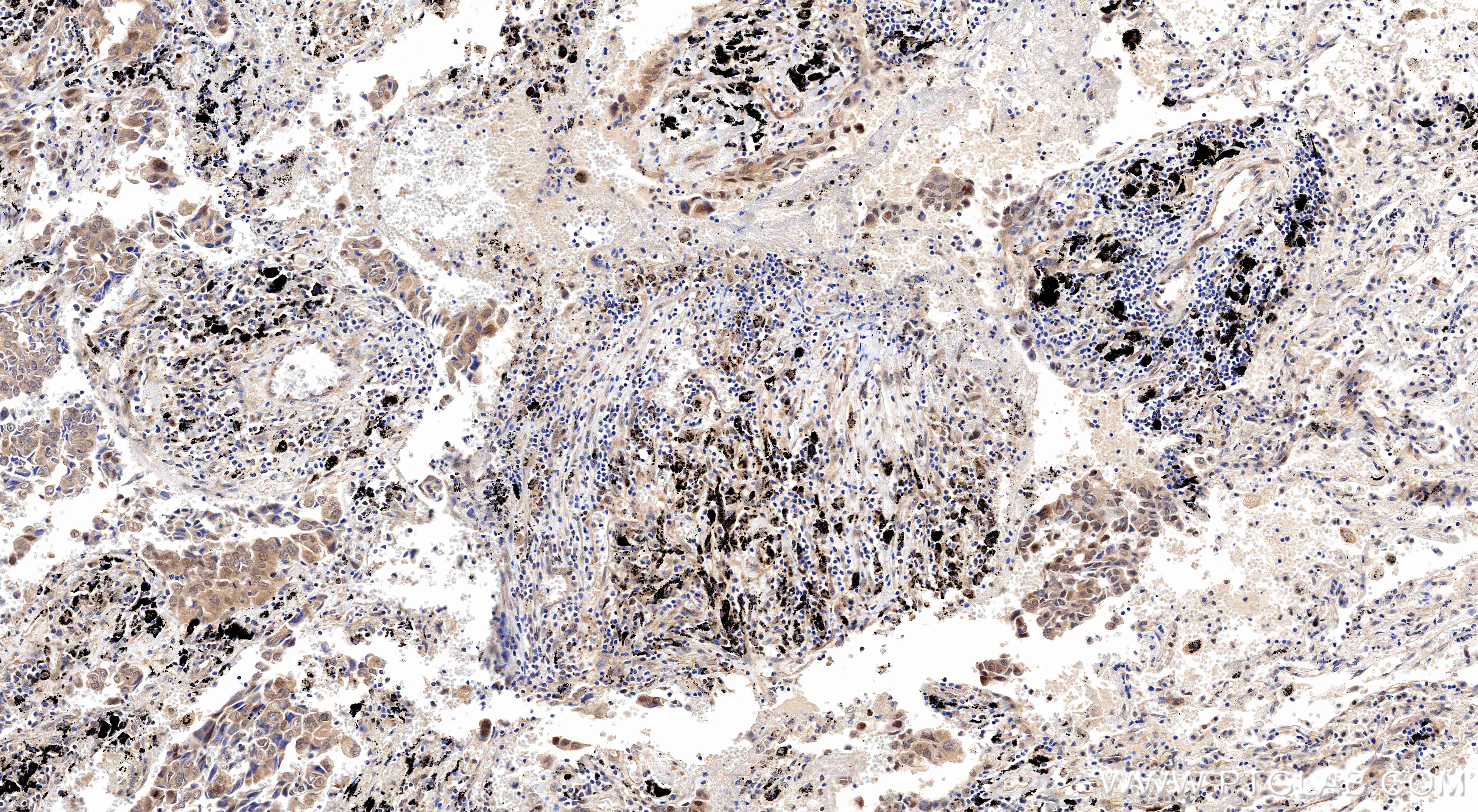 IHC staining of human lung cancer using 86176-2-RR