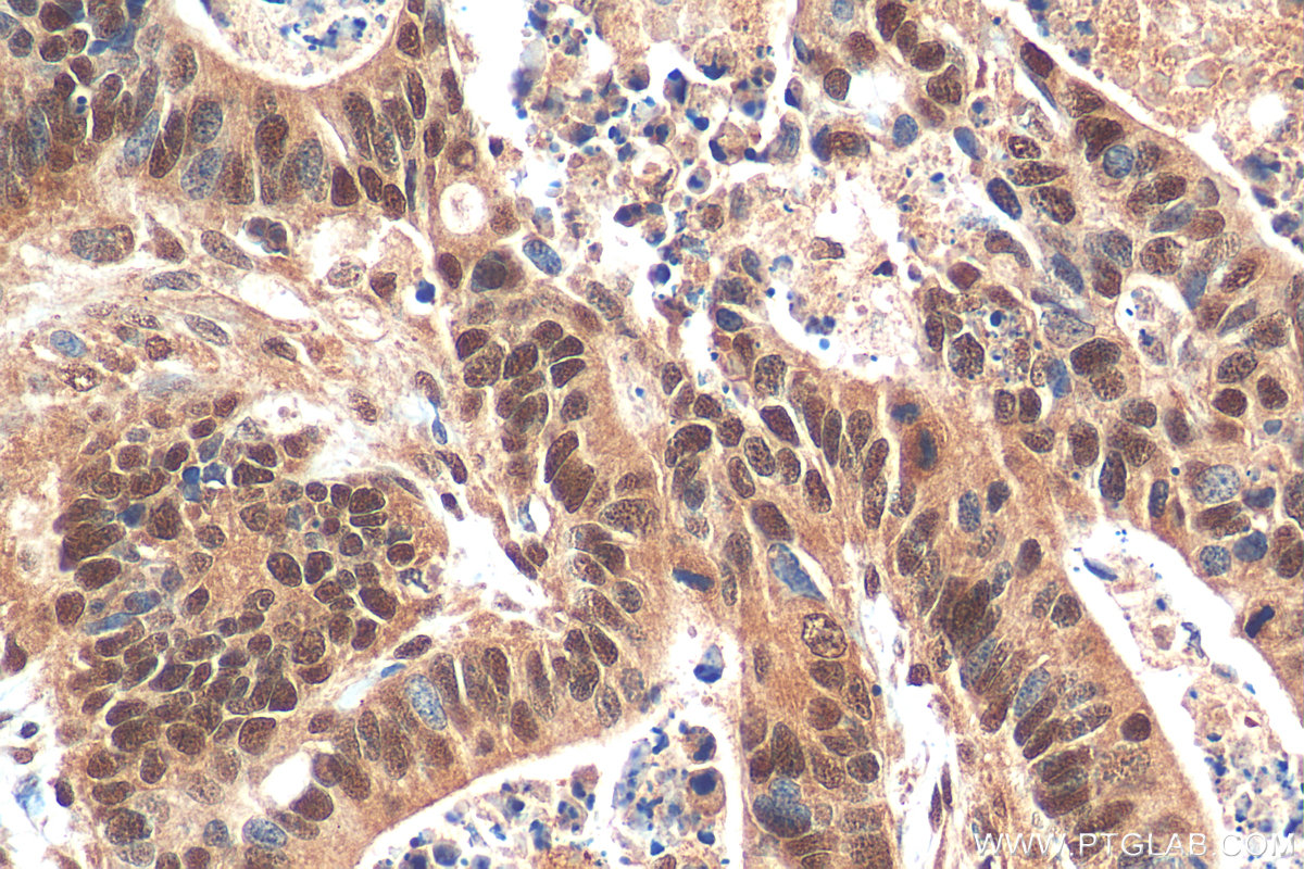 IHC staining of human colon cancer using 24785-1-AP