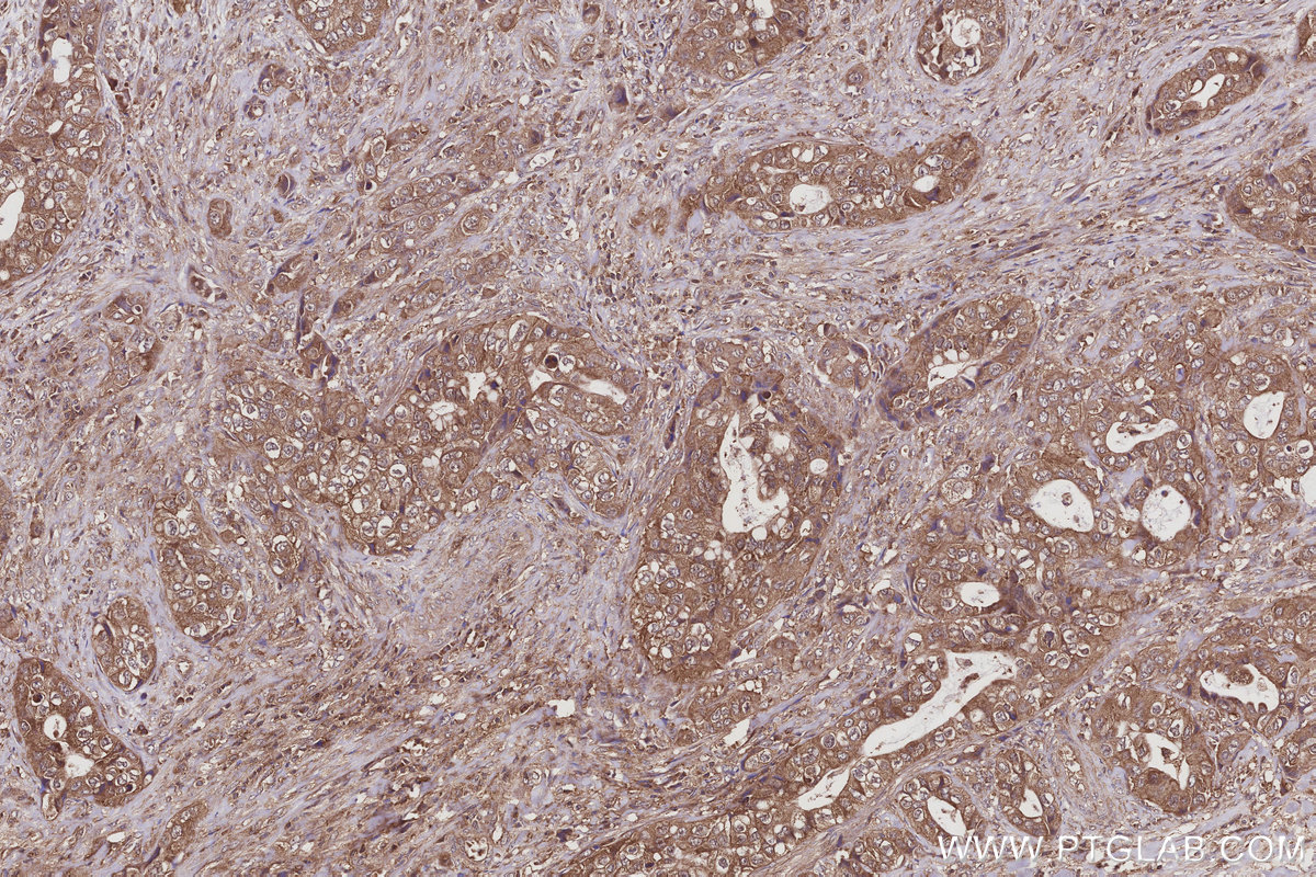 IHC staining of human pancreas cancer using 66356-1-Ig IHC staining of human pancreas cancer using 66356-1-Ig