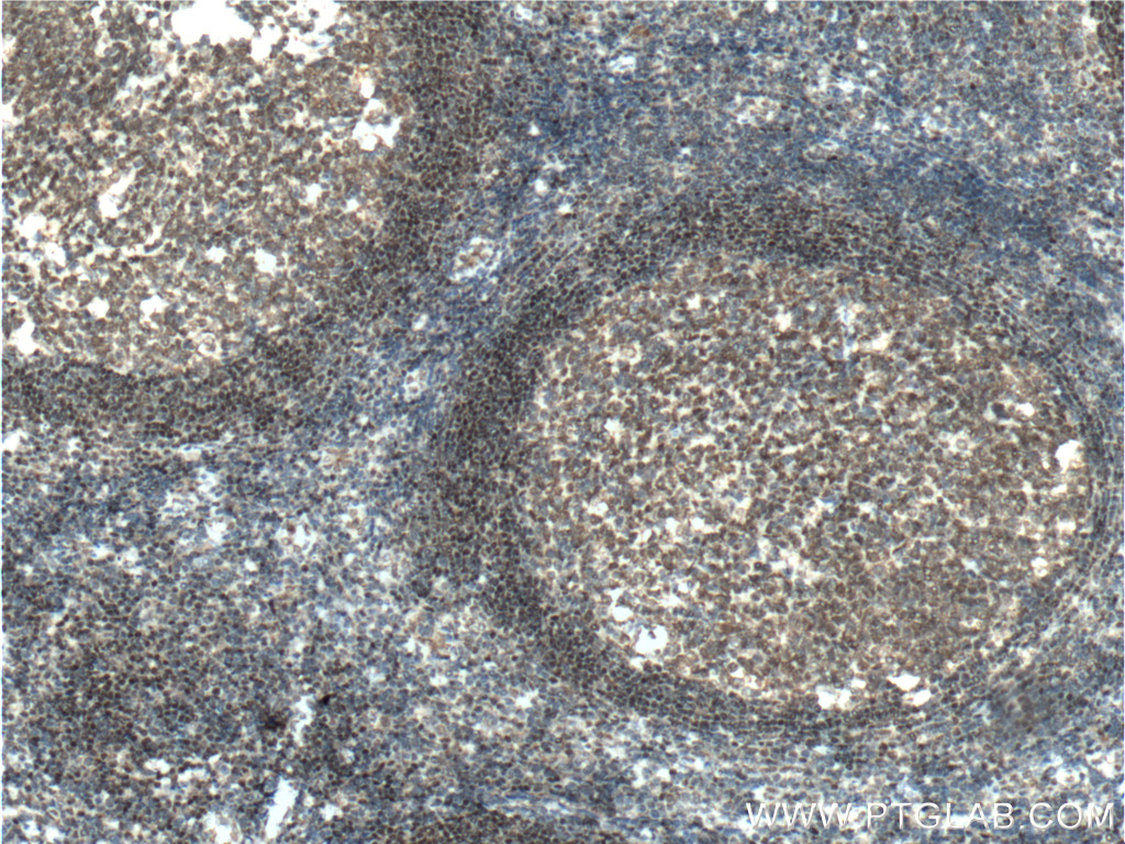 IHC staining of human tonsillitis using 60349-1-Ig (same clone as 60349-1-PBS)
