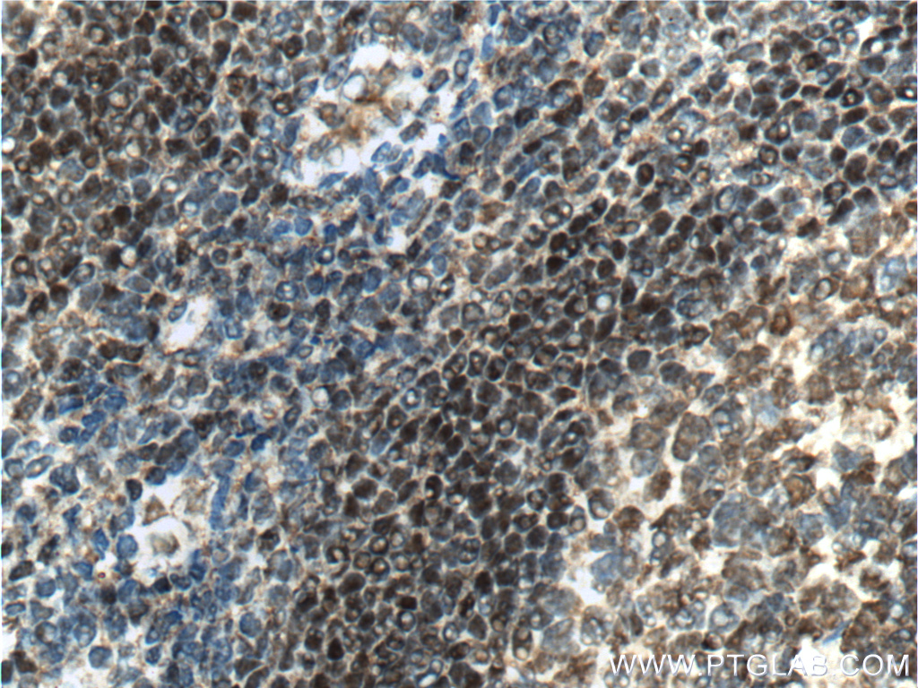 IHC staining of human tonsillitis using 60349-1-Ig (same clone as 60349-1-PBS)