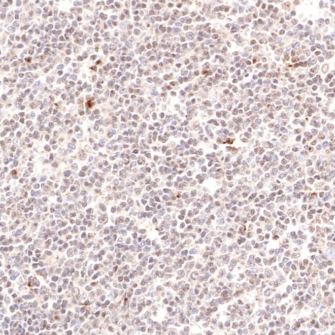 IHC staining of human lymphoma using 60349-1-Ig IHC staining of human lymphoma using 60349-1-Ig