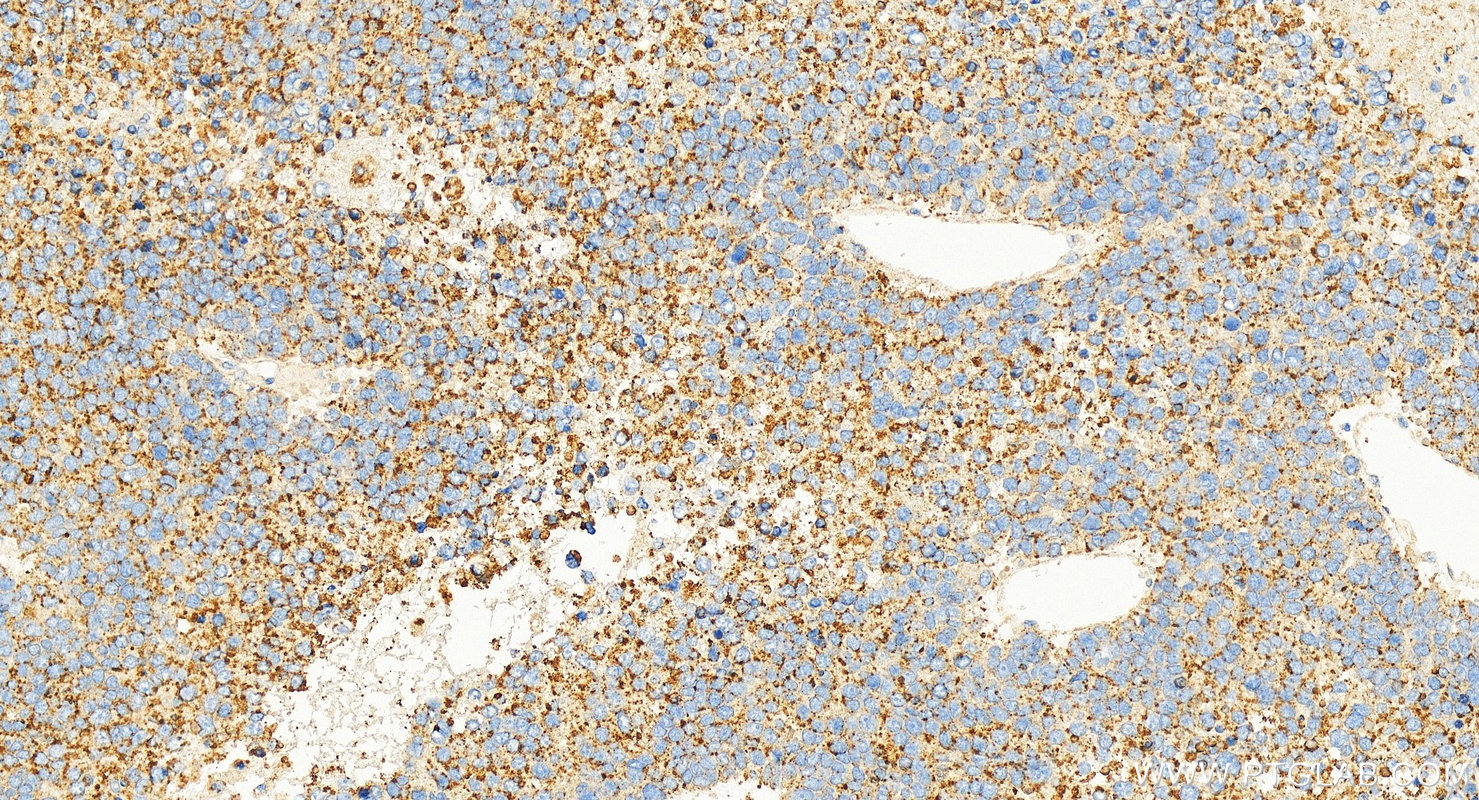 Immunohistochemical analysis of paraffin-embedded human hepatocellular carcinoma slide using 67512-1-Ig (BSEP antibody) at dilution of 1:16000 (under 20x lens). Heat mediated antigen retrieval with Tris-EDTA buffer (pH 9.0). IHC staining of human hepatocellular carcinoma using 67512-1-Ig
