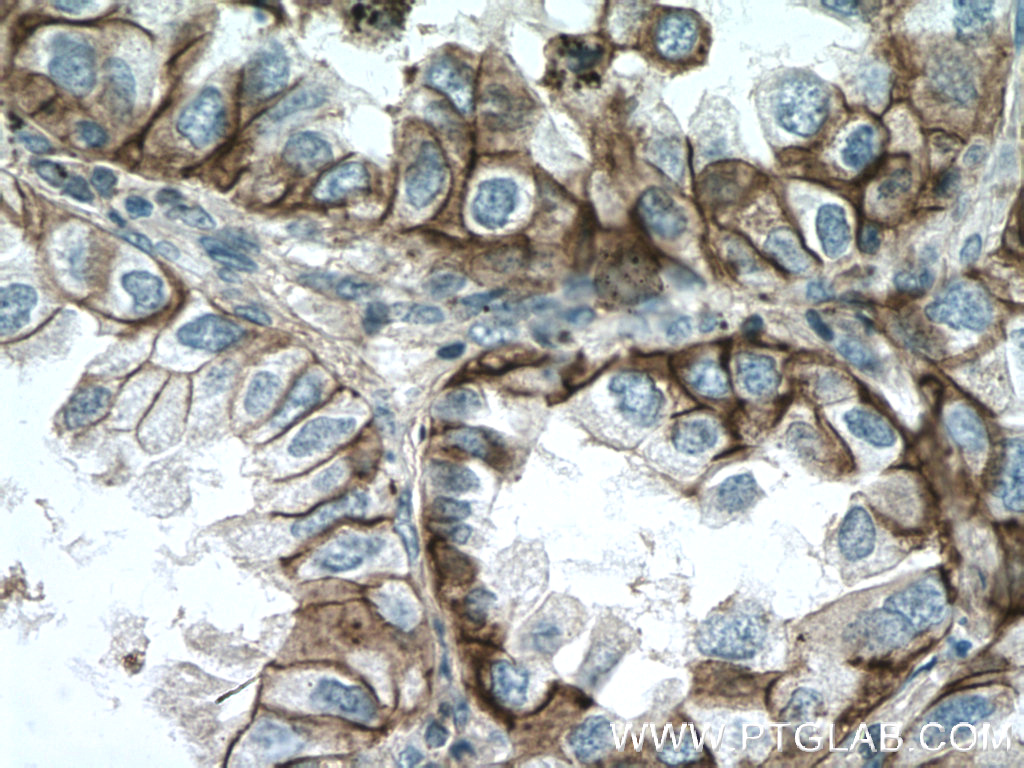 IHC staining of human lung cancer using 11989-1-AP