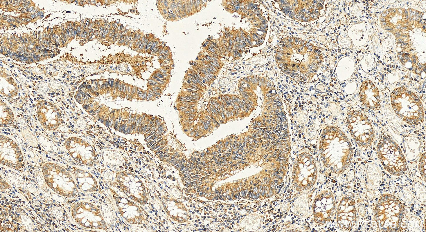 IHC staining of human colon cancer using 15415-1-AP