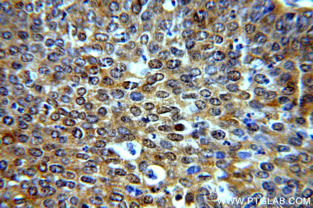 Immunohistochemical analysis of paraffin-embedded human cervical cancer using 19753-1-AP (BTF3L3-Specific antibody) at dilution of 1:50 (under 40x lens). IHC staining of human cervical cancer using 19753-1-AP