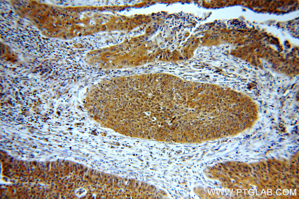 Immunohistochemical analysis of paraffin-embedded human cervical cancer using 19753-1-AP (BTF3L3-Specific antibody) at dilution of 1:50 (under 10x lens). IHC staining of human cervical cancer using 19753-1-AP