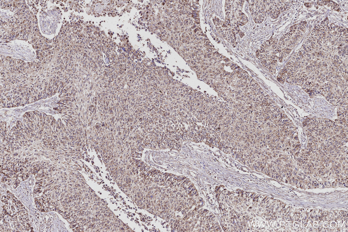 IHC staining of human lung cancer using 20514-1-AP IHC staining of human lung cancer using 20514-1-AP