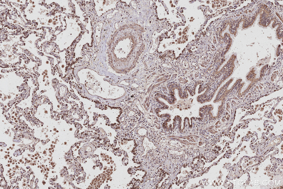 IHC staining of human lung cancer using 20514-1-AP IHC staining of human lung cancer using 20514-1-AP