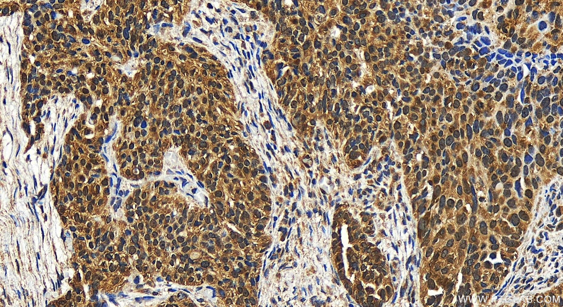 IHC staining of human ovary cancer using 28319-1-AP