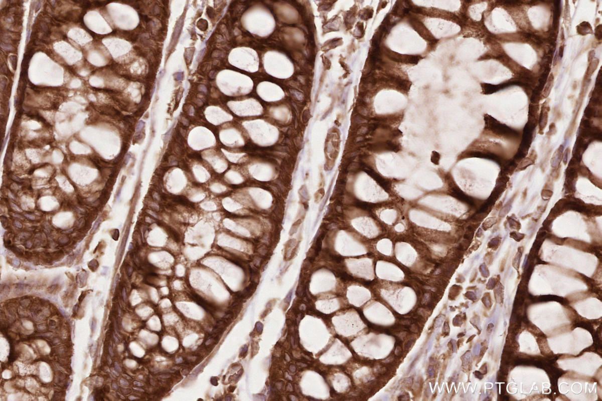IHC staining of human rectal cancer using 19917-1-AP