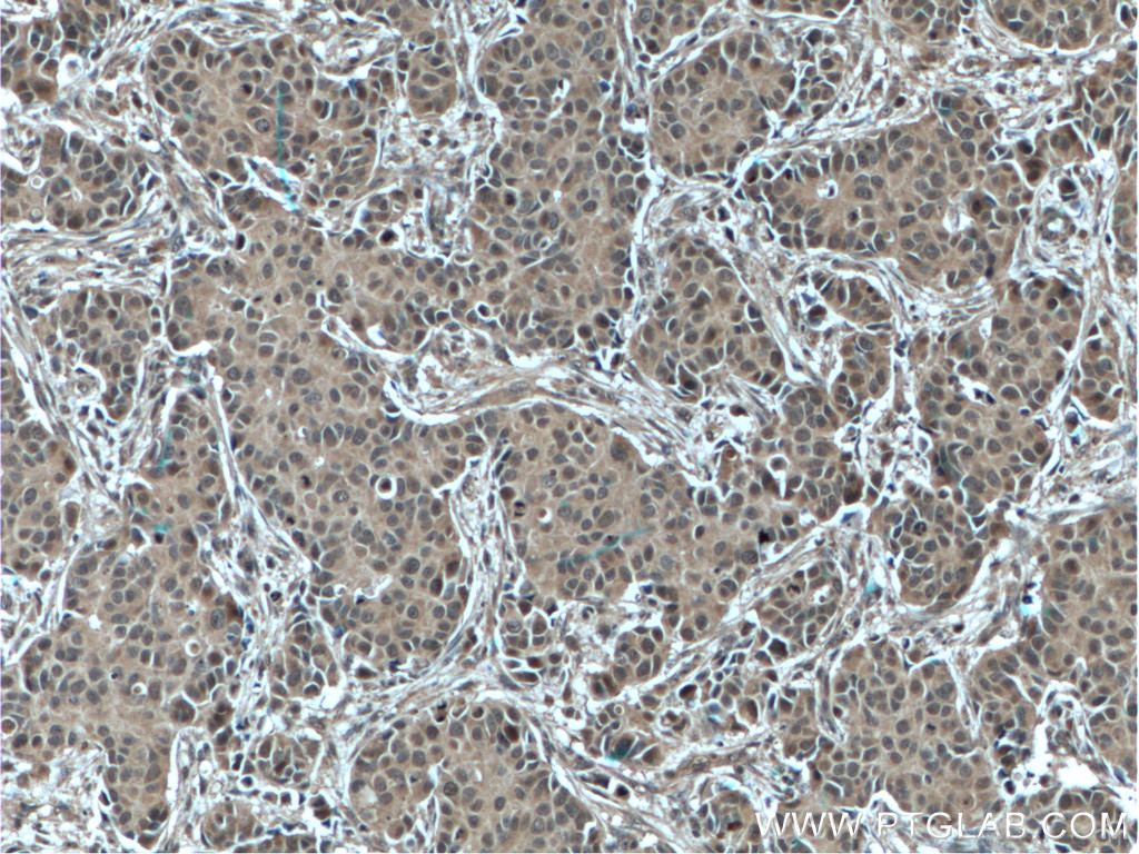 IHC staining of human breast cancer using 66020-1-Ig