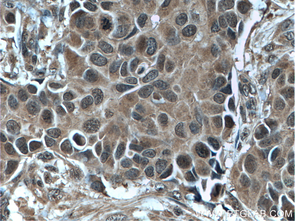 IHC staining of human breast cancer using 66020-1-Ig