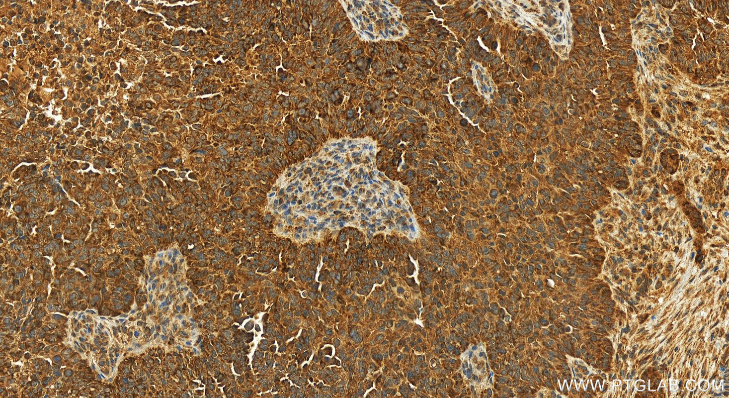 Immunohistochemical analysis of paraffin-embedded human ovarian cancer slide using 83330-1-RR (Bcl-XL antibody) at dilution of 1:200 (under 20x lens). Heat mediated antigen retrieval with Tris-EDTA buffer (pH 9.0). IHC staining of human ovarian cancer using 83330-1-RR
