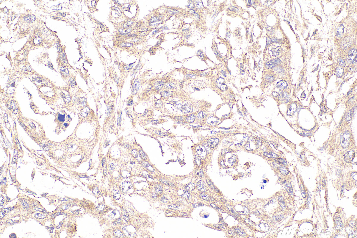 IHC staining of human colon cancer using 66665-1-Ig